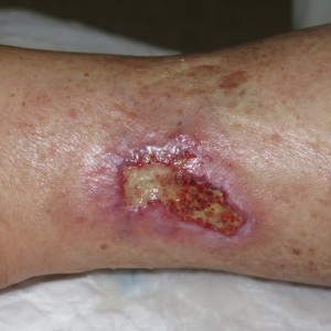 Martorell ulcer 2