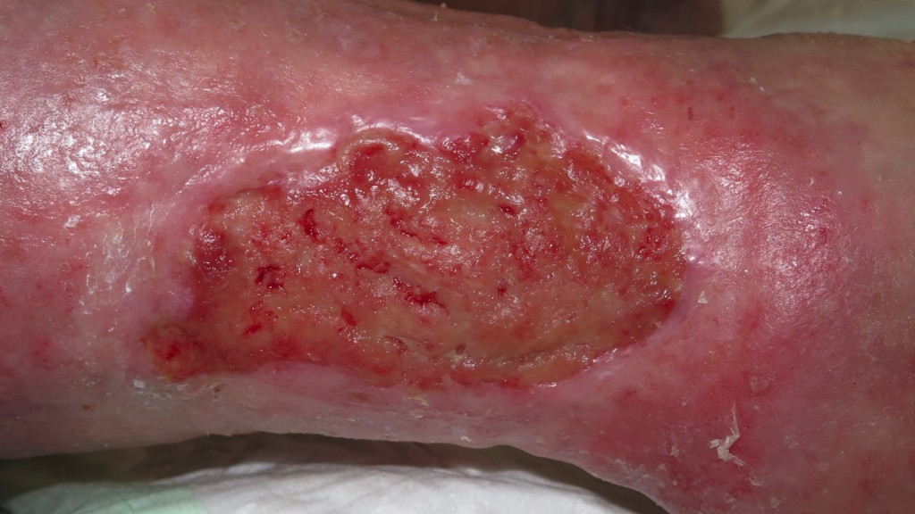 Fibrinous tissue in venous ulcers: what are we talking about?