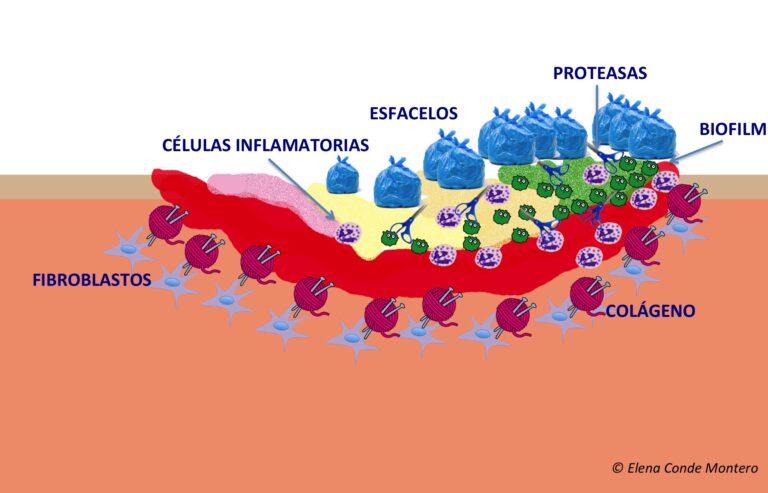 Tejido fibrinoso en las úlceras venosas: ¿de qué estamos hablando?