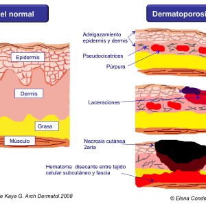 Grados de afectación de la dermatoporosis