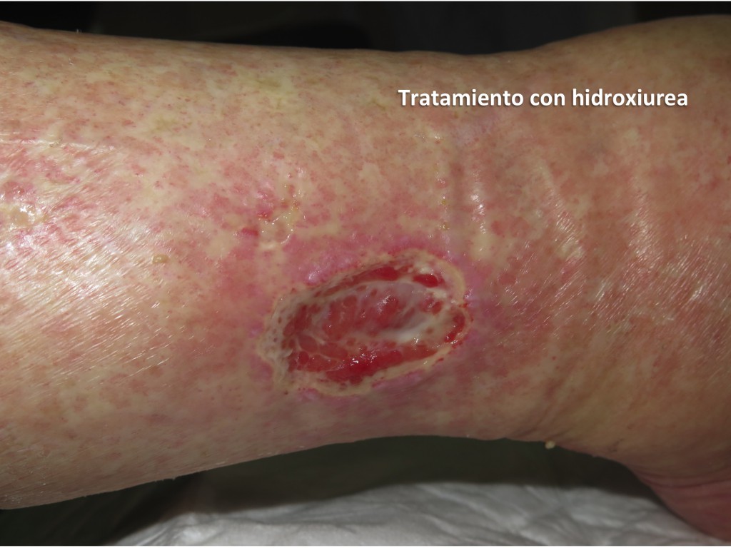 La Compresión Es Clave En El Tratamiento De Las Heridas En Las Piernas Elena Conde Montero 2179