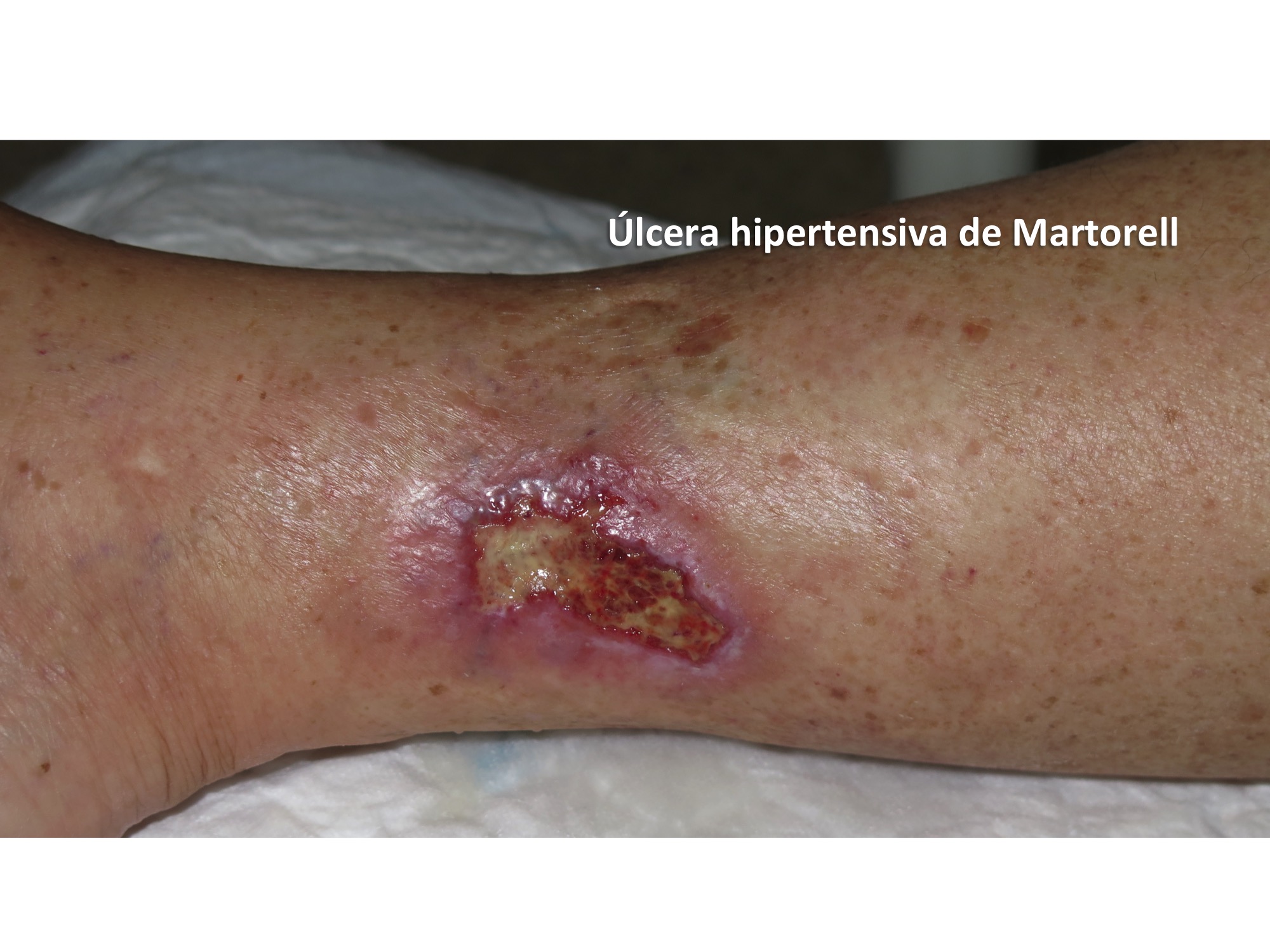 6 motivos por los que una úlcera venosa no cierra a pesar de la terapia  compresiva - Elena Conde Montero