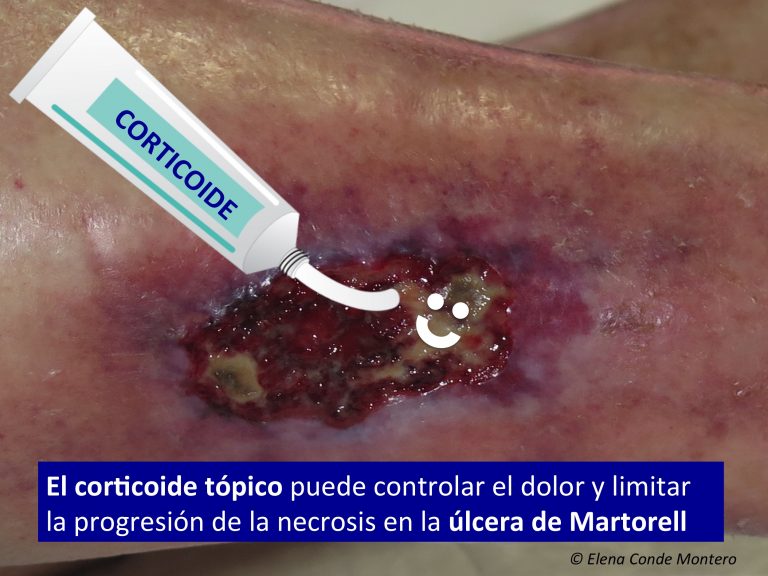 El interés del corticoide tópico en la úlcera de Martorell