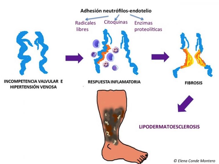 La insuficiencia venosa crónica desde una perspectiva dermatológica