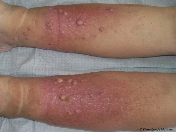 Chronic venous insufficiency from a dermatological perspective - Elena ...