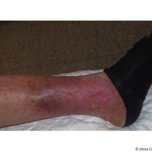eczema compression
