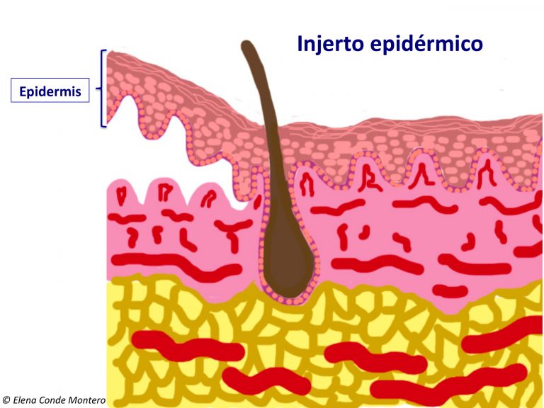 Diferencias entre los injertos epidérmicos y dermo-epidérmicos en sello