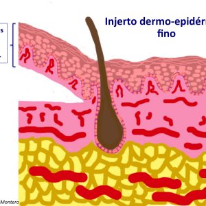 Injerto dermo-epidérmico fino