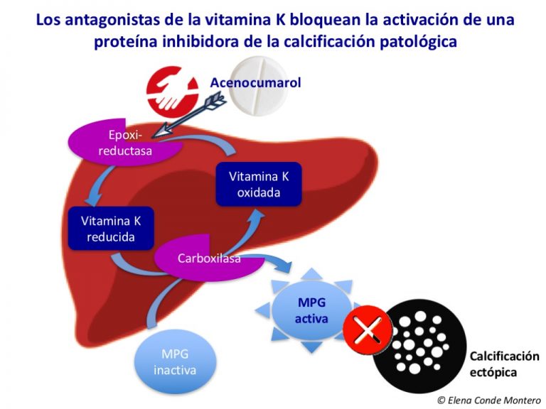 La úlcera de Martorell y los antagonistas de la vitamina K: una combinación peligrosa