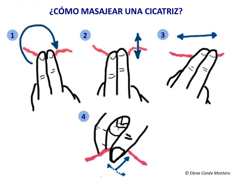 Terapia compresiva y masaje de la cicatriz en heridas de pierna por traumatismo o cirugía