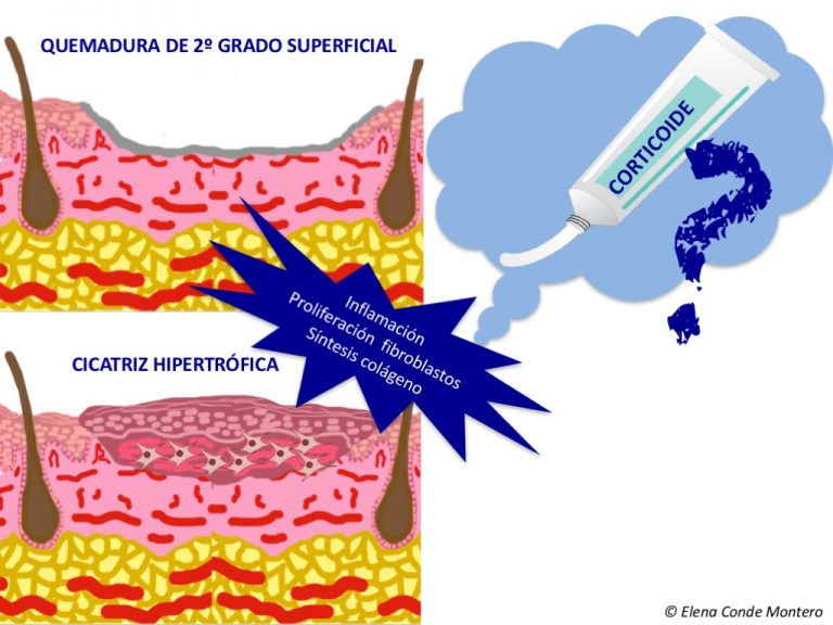 ¿Tiene lógica aplicar corticoide tópico para mejorar la cicatrización de las quemaduras superficiales?