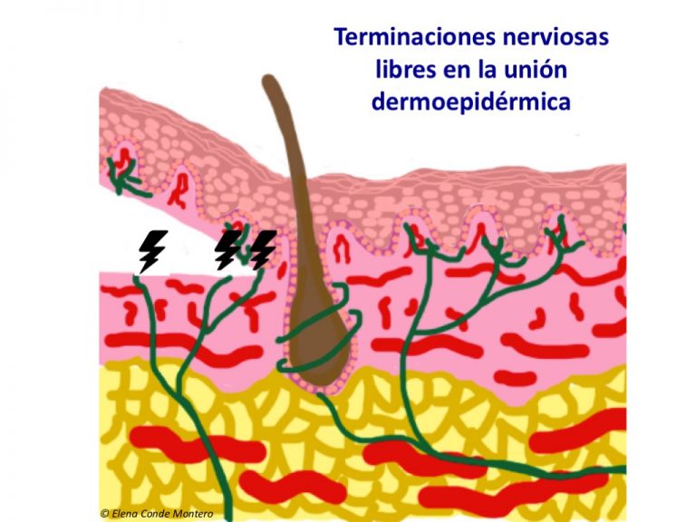 ¿Qué apósito elijo para cubrir la zona donante de injerto cutáneo?