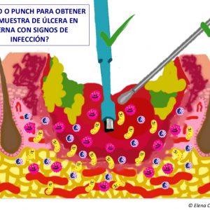 Hisopo Punch Úlcera infectada