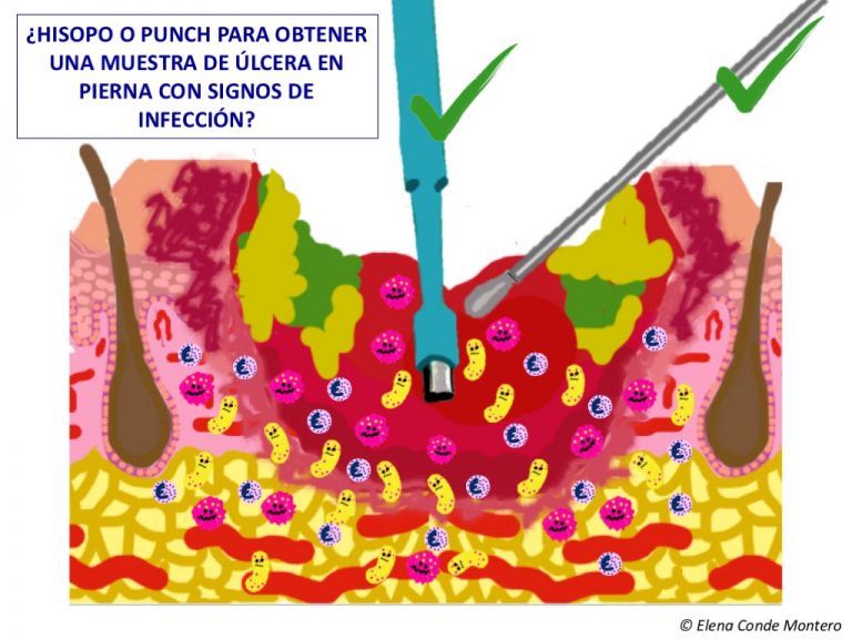 Sospecha de infección en una herida de pierna: ¿haces frotis con hisopo o biopsia con punch?