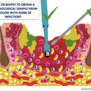 SWAB BIOPSY WOUND INFECTION