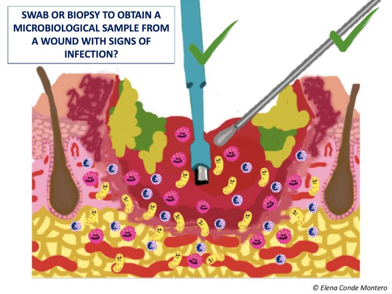 Suspected infection in a leg ulcer: swab or punch biopsy?