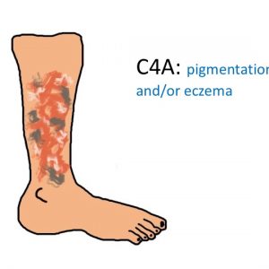 C4A pigmentation and:or eczema