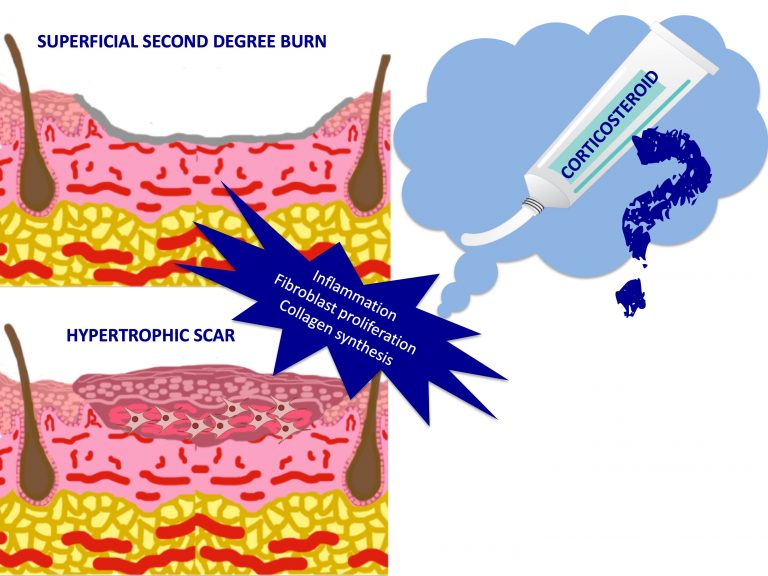 Does it make sense to apply topical corticosteroids to improve the healing of superficial burns?