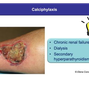 martorell ulcer