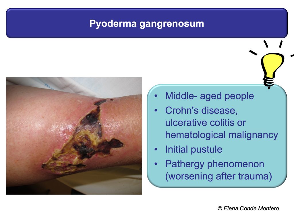 Necrosis and purple edges in leg ulcers: keys to guide your diagnosis