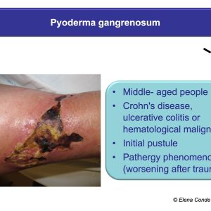 pyoderma gangrenosum