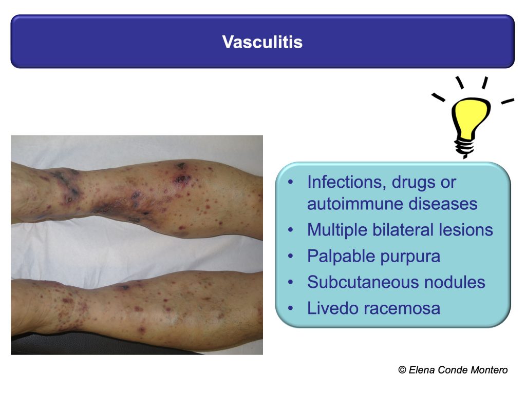 Necrosis and purple edges in leg ulcers: keys to guide your diagnosis