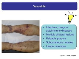 Necrosis and purple edges in leg ulcers: keys to guide your diagnosis