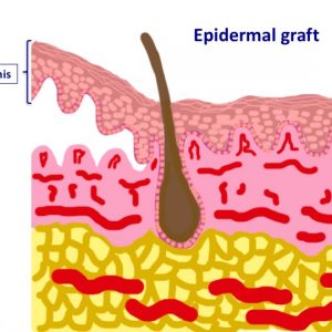 Epidermal graft