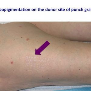 Hypopigmentation donor site