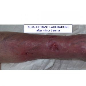 RECALCITRANT LACERATIONS