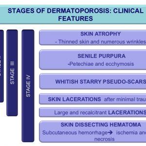 STAGES OF DERMATOPOROSIS