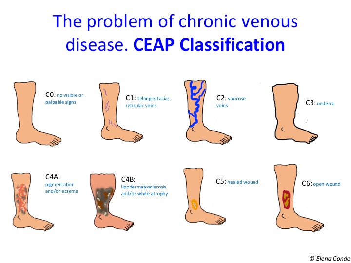 Skin Changes In Venous Insufficiency - Laurel Clinical