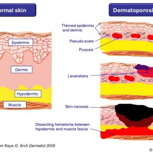 STAGES OF DERMATOPOROSIS - Elena Conde Montero