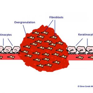 overgranulation