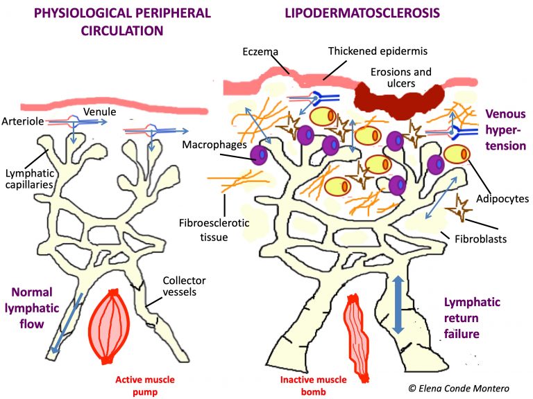 Phlebolymphedema, a term that should be more used