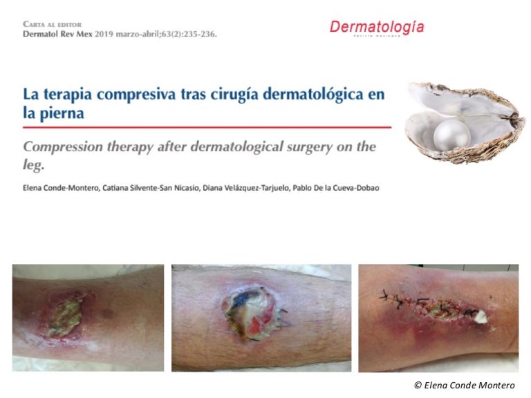 Compression therapy after dermatologic surgery on the leg