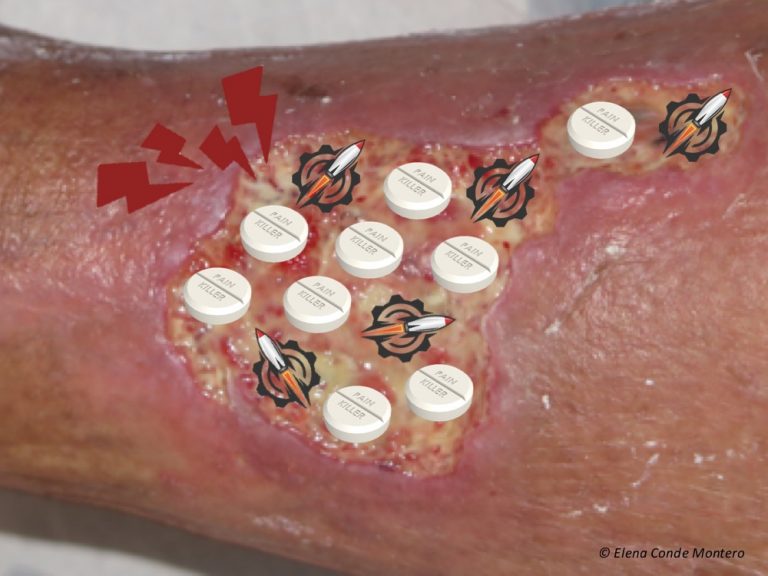 Therapeutic Pearl: Punch grafting in suboptimal wound beds