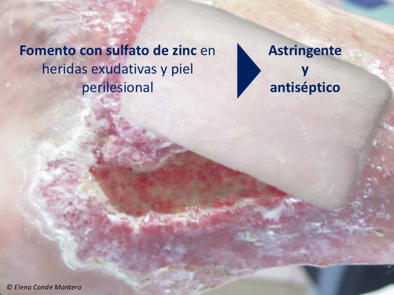 Fomentos astringentes y antisépticos en heridas y piel perilesional