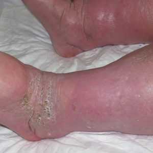 Phlebolymphedema 1