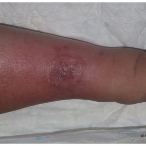 Phlebolymphedema 4