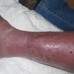 Phlebolymphedema 5