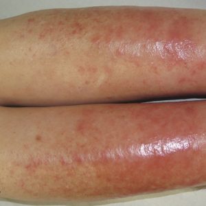 Phlebolymphedema 6