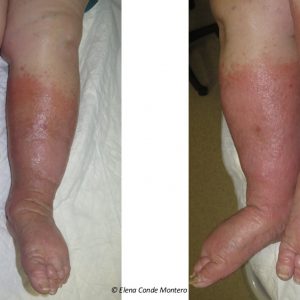 Phlebolymphedema 7