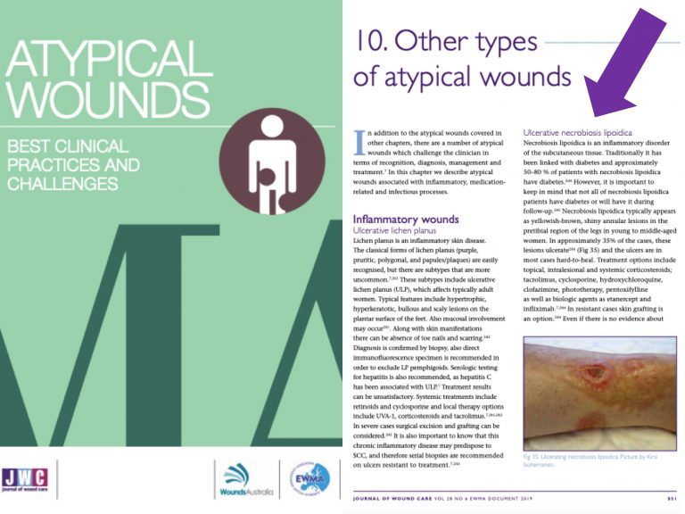 Ulcerated necrobiosis lipoidica: what is it and how should it be managed?