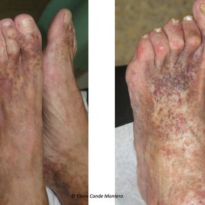 Acroangiodermatitis 1