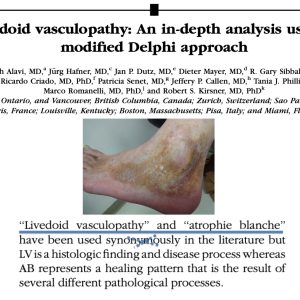 Livedoid vasculopathy