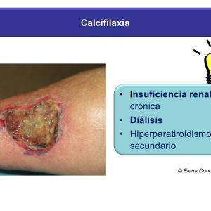 Calcifilaxia