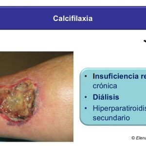 Calcifilaxia