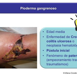 Pioderma gangrenoso necrosis