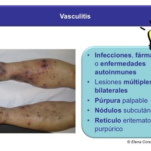 Vasculitis necrosis